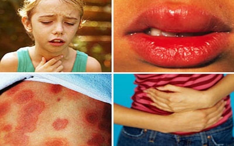 dị ứng thuốc giảm đau