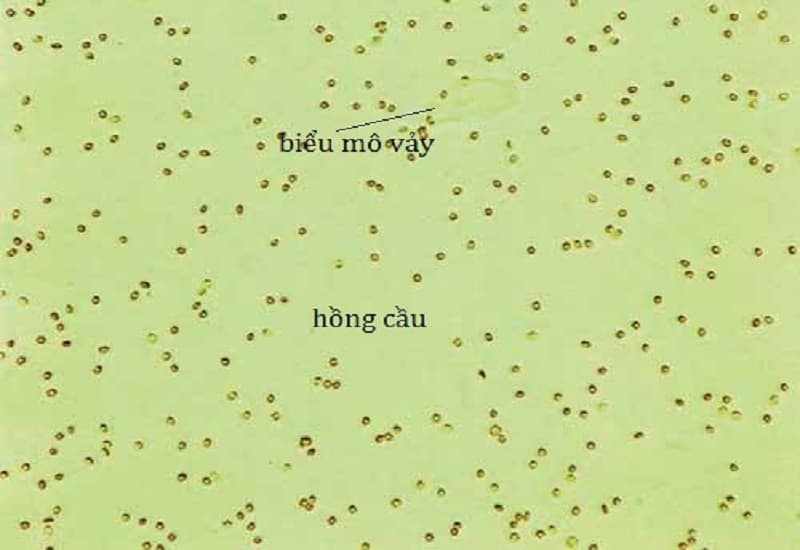epithelial cells trong xét nghiệm nước tiểu