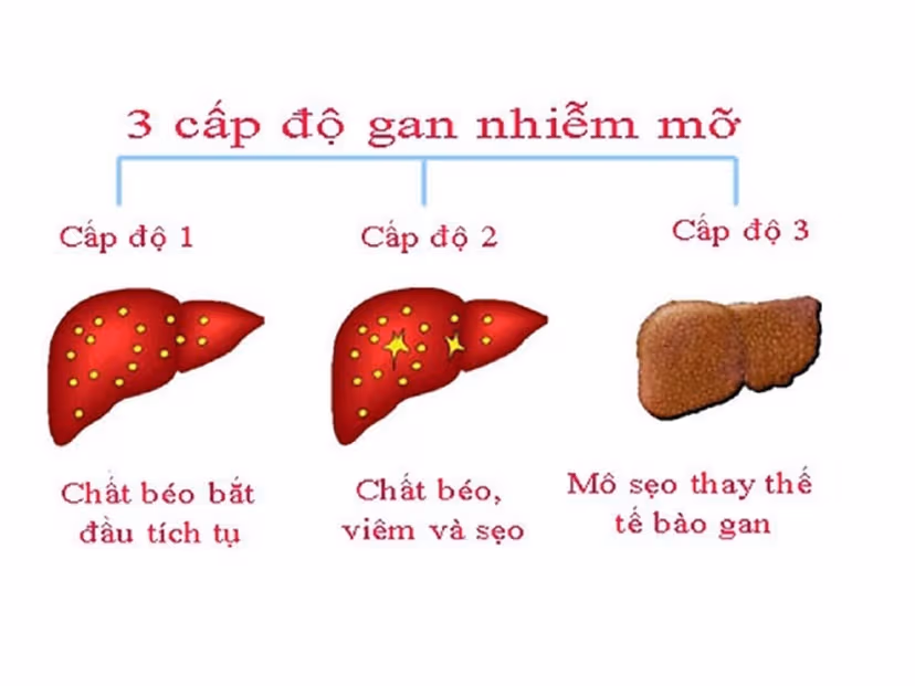 Chỉ số nào cho thấy gan nhiễm mỡ độ 2?