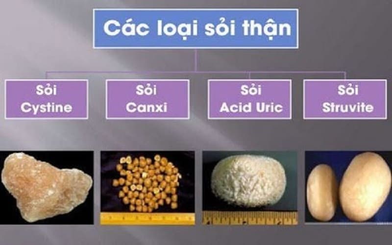 Sỏi thận và sỏi mật cái nào nguy hiểm hơn?