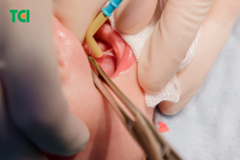 Tình trạng dính thắng lưỡi sẽ khiến trẻ khó đưa hoặc nâng lưỡi, từ đó ảnh hưởng đến bú, nuốt và cả phát âm sau này.