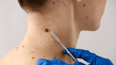 Hình ảnh nốt ruồi bất thường, khối u ác tính và những thay đổi trên da