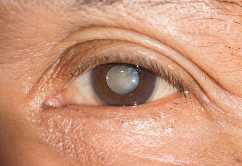 mắt bị đục thủy tinh thể có chữa được không