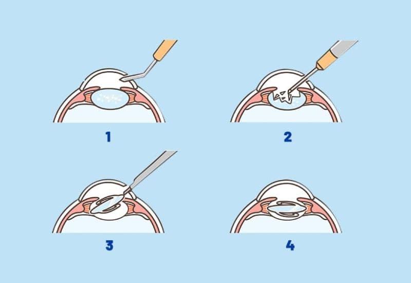 mắt bị đục thủy tinh thể có chữa được không