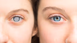 Mắt bị đục thủy tinh thể có chữa được không?