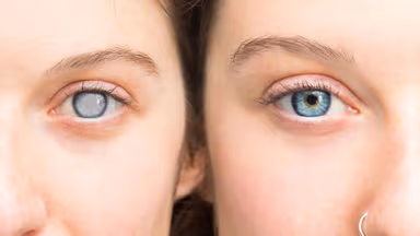 Mắt bị đục thủy tinh thể có chữa được không?