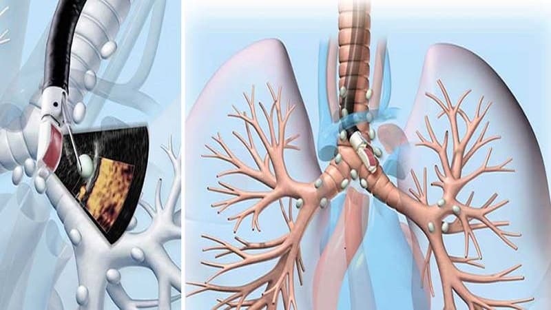 nội soi phế quản để làm gì