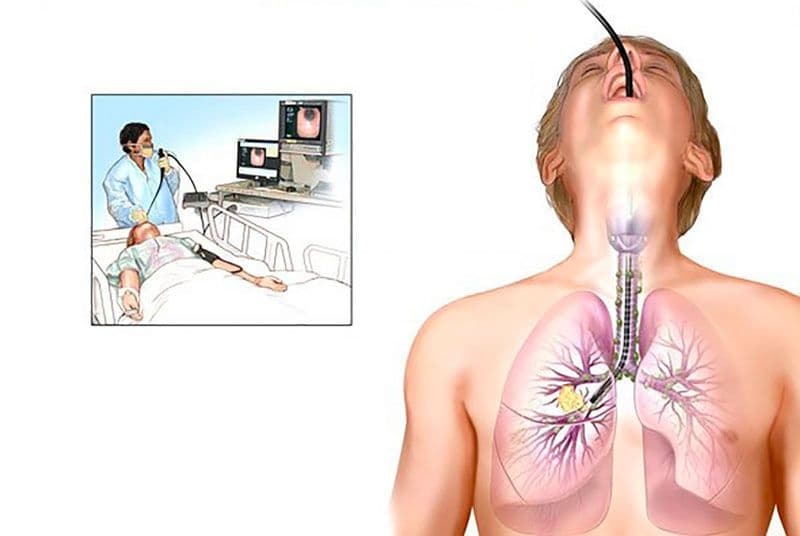nội soi phế quản để làm gì