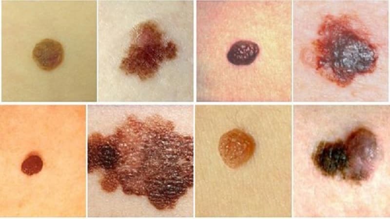 hình ảnh nốt ruồi ung thư