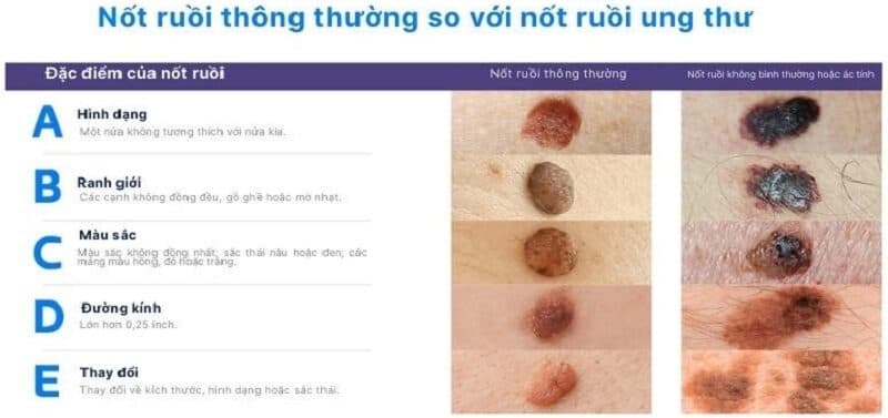hình ảnh nốt ruồi ung thư