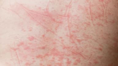 Đặc điểm nhận diện nốt sốt xuất huyết chính xác