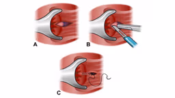 Phẫu thuật cắt cơ thắt trong: Cách chữa nứt kẽ hậu môn hiệu quả