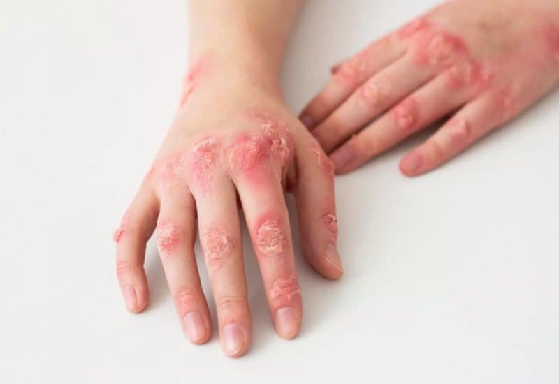 dấu hiệu bệnh Lupus ban đỏ giai đoạn đầu