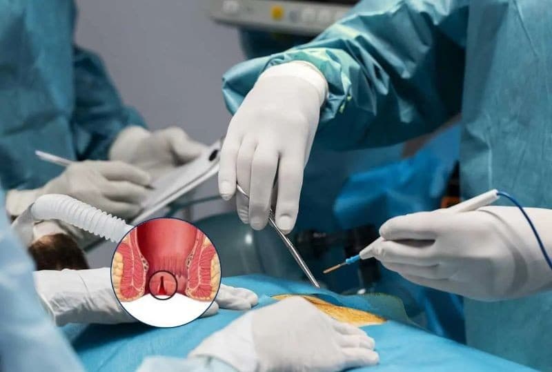 nứt kẽ hậu môn và cách chữa