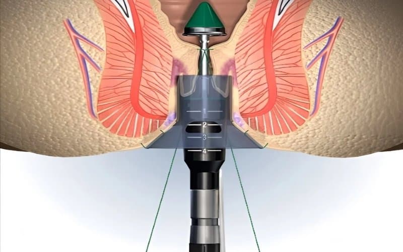 mổ trĩ longo bao lâu lành