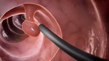 Polyp dạ dày có phải là ung thư không?