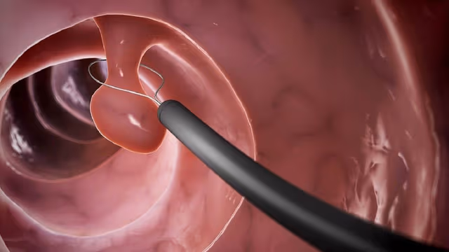 Polyp dạ dày có phải là ung thư không?