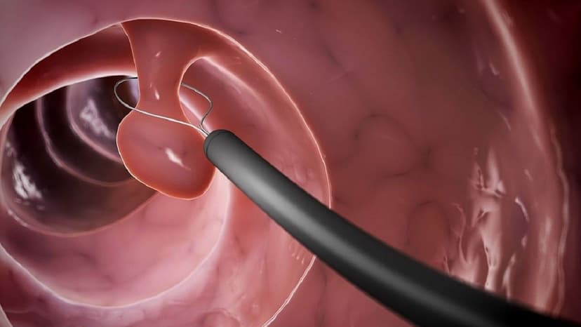 Polyp dạ dày có phải là ung thư không?