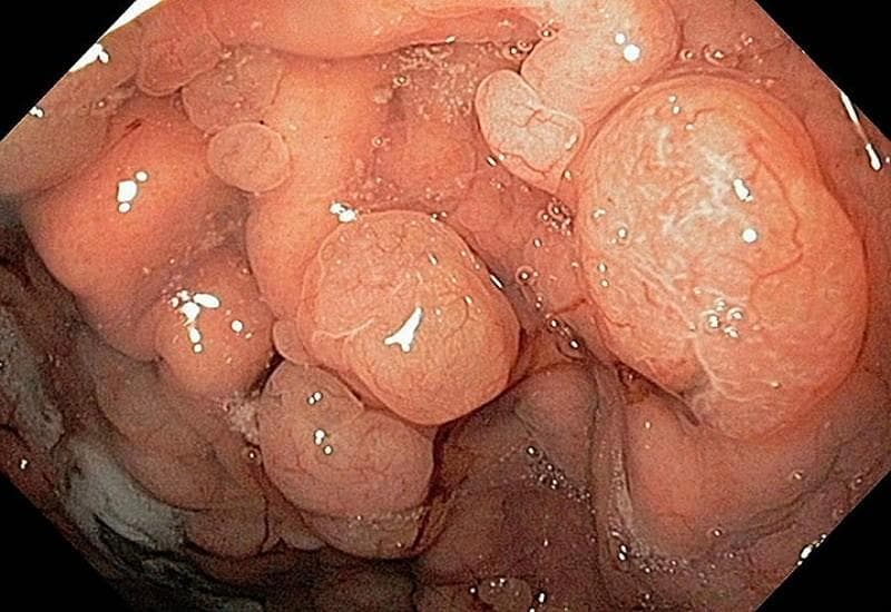 polyp dạ dày có phải là ung thư không?