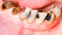 Vì sao răng bị viêm tủy?