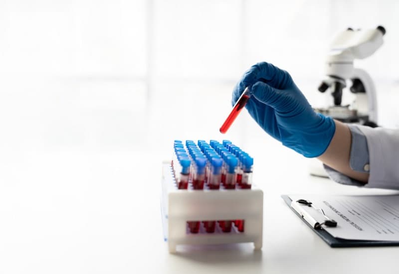 RDW CV cao trong xét nghiệm máu là gì