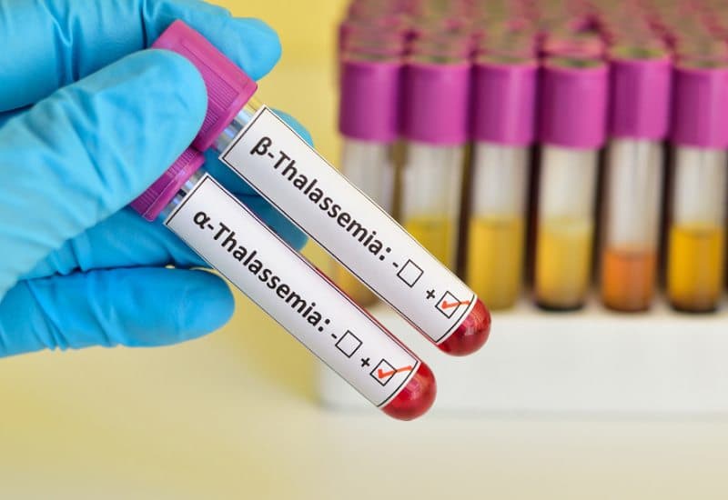 RDW CV cao trong xét nghiệm máu là gì