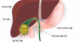 Sỏi túi mật 20mm có nguy hiểm không?