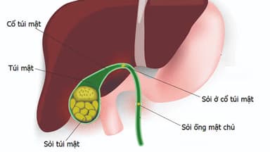 Sỏi túi mật 20mm có nguy hiểm không?
