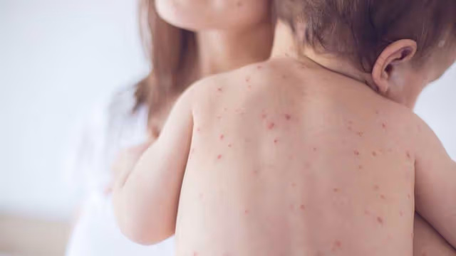 Những triệu chứng sốt xuất huyết ở trẻ em 7 tuổi theo từng giai đoạn