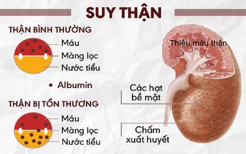suy thận và sỏi thận khác nhau như thế nào