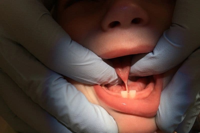 các cấp độ dính thắng lưỡi