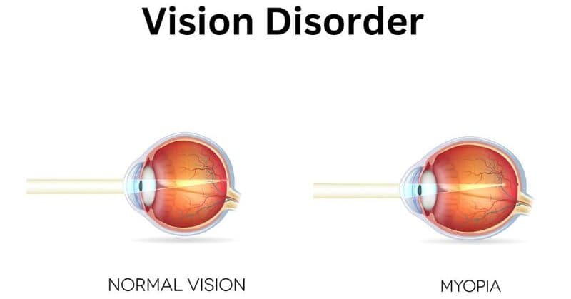 thoái hóa võng mạc do cận thị