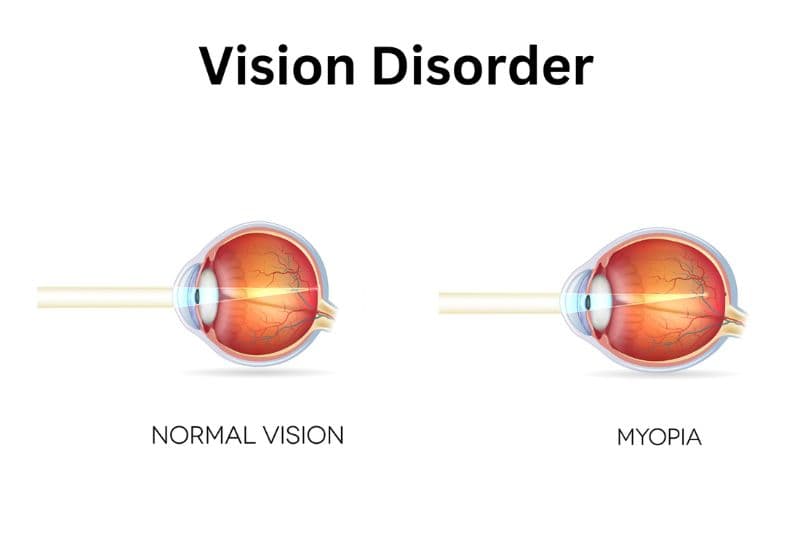 thoái hóa võng mạc do cận thị