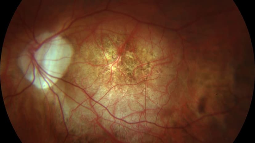 Cảnh giác thoái hóa võng mạc do cận thị