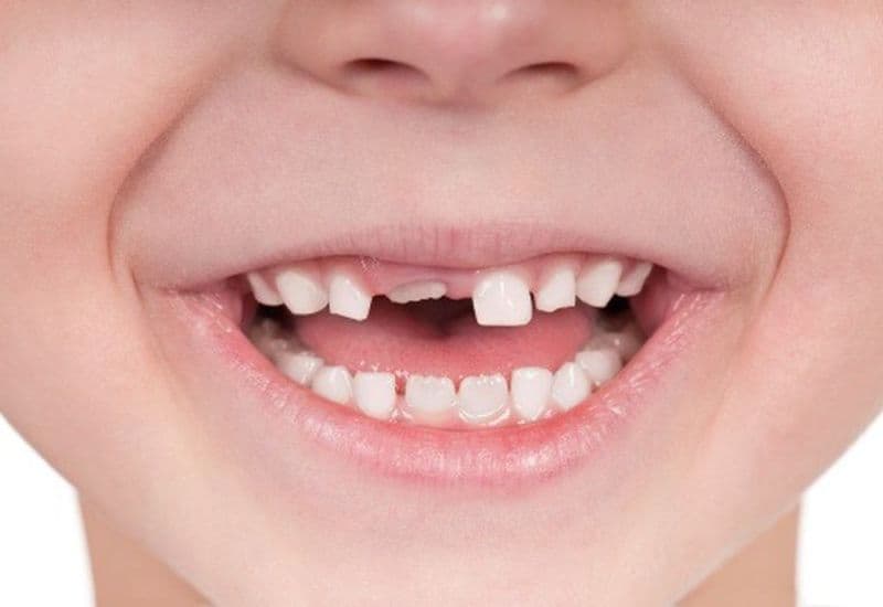 Thứ tự thay răng sữa ở trẻ em theo tuổi