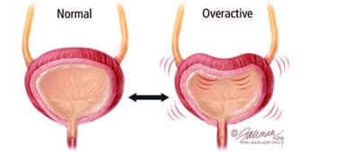 Các thuốc có thể gây ra bàng quang hoạt động quá mức