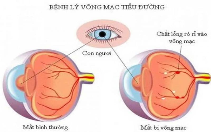 thuốc sáng mắt cho người tiểu đường