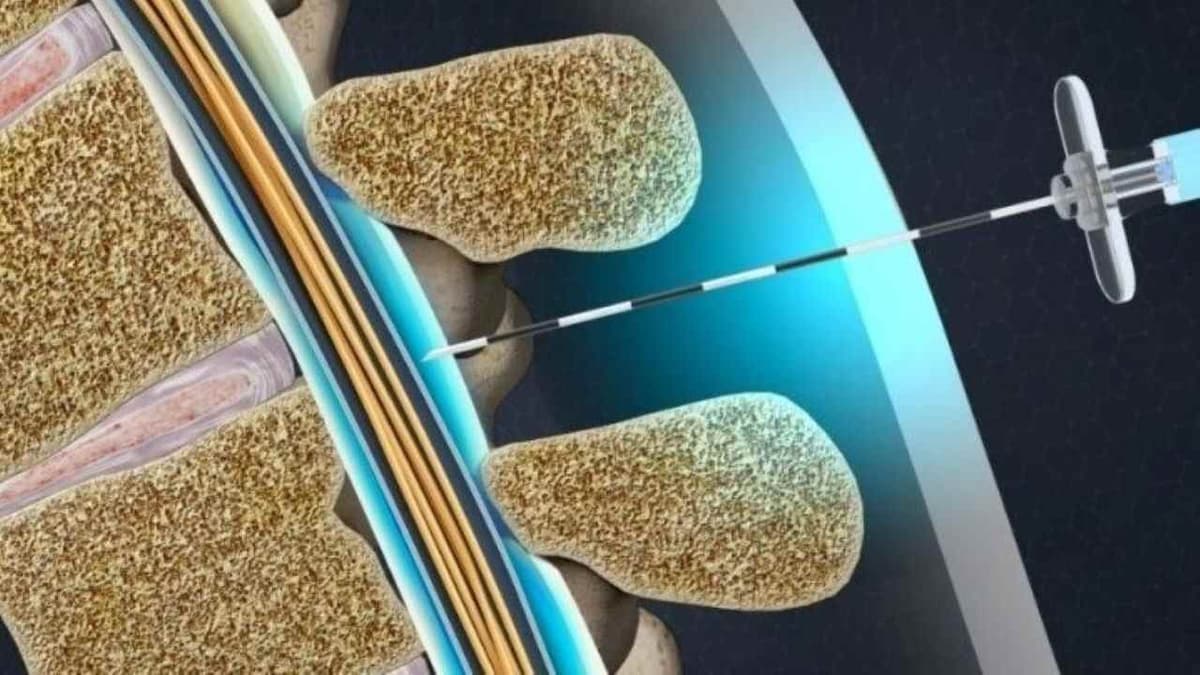 Tiêm màng cứng thoát vị đĩa đệm có hại không?