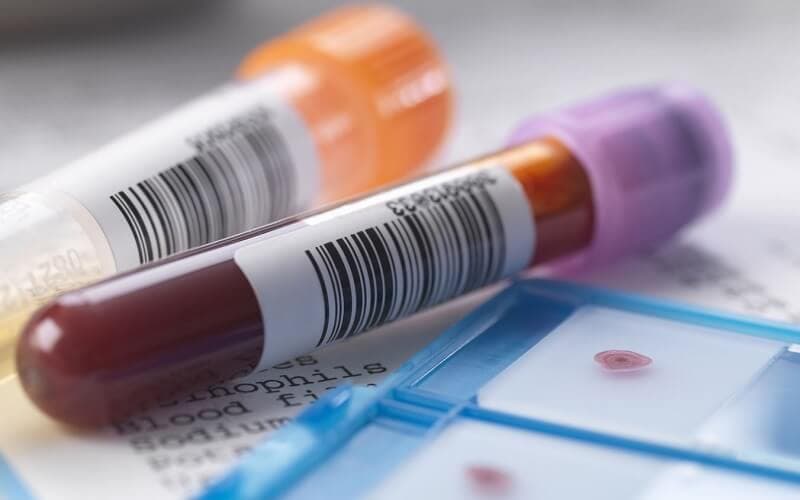 mpv cao trong xét nghiệm máu là gì