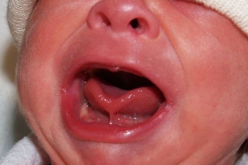 các cấp độ dính thắng lưỡi