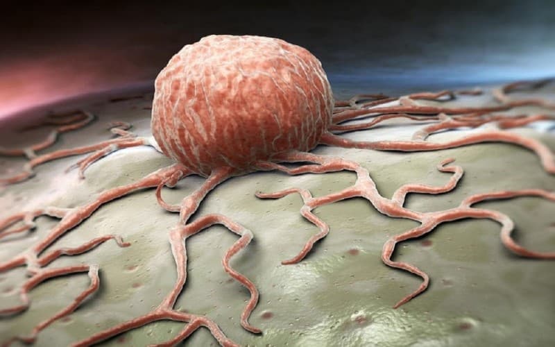 u tân sinh có phải ung thư không