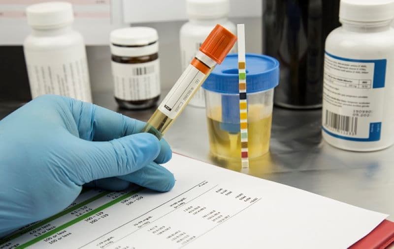 UBG trong xét nghiệm nước tiểu là gì