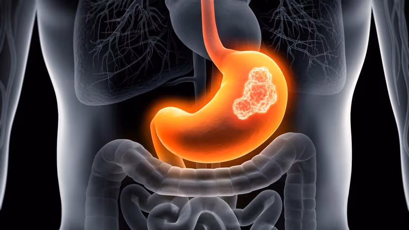 Dấu hiệu điển hình ung thư dạ dày giai đoạn 1