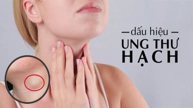 Ung thư hạch có nguy hiểm không?