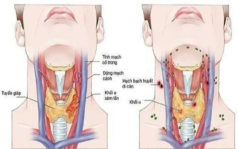 siêu âm cổ có phát hiện ung thư vòm họng