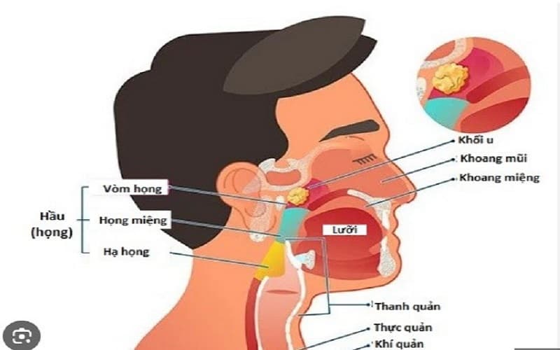 ung thư vòm họng nổi hạch ở đâu