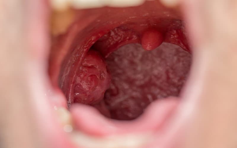 viêm amidan mạn tính có gây ung thư không