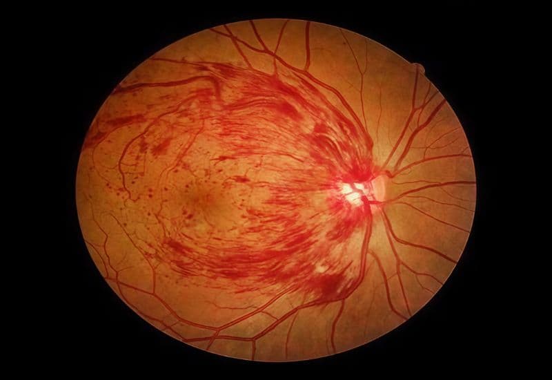 viêm hắc võng mạc