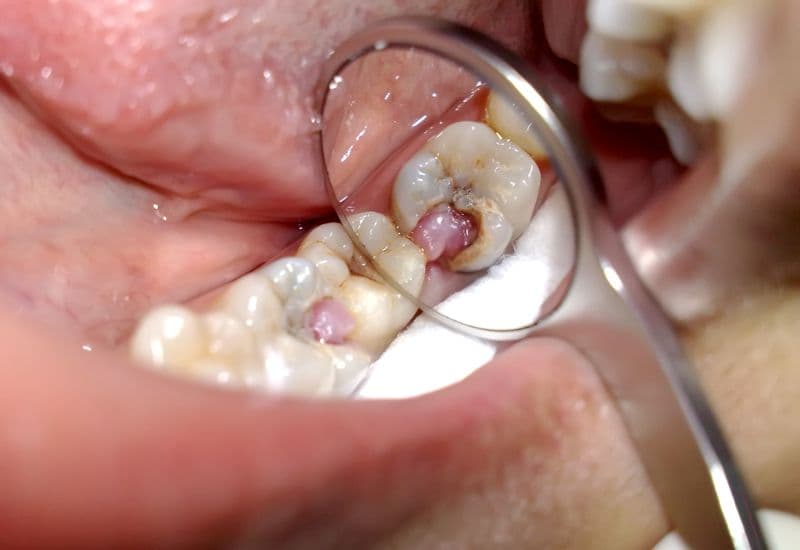 viêm tủy răng có hồi phục