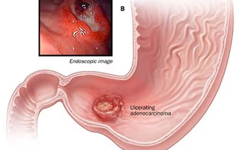 xét nghiệm máu có phát hiện ung thư dạ dày